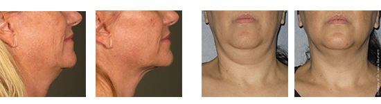 Ultherapy